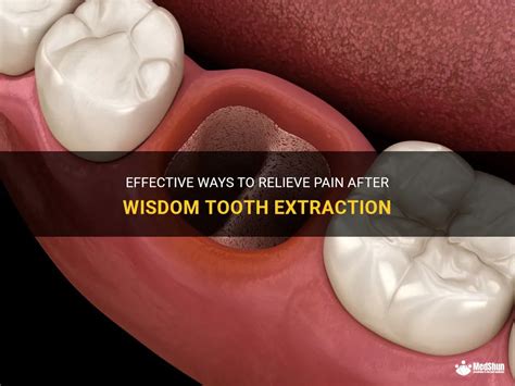 Effective Ways To Relieve Pain After Wisdom Tooth Extraction Medshun