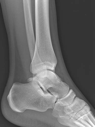 Lateral Ankle Radiography Wikiradiography