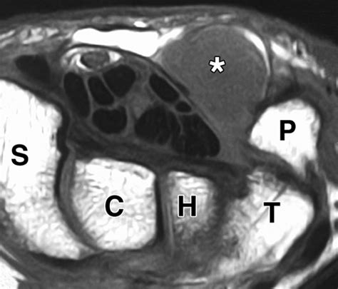 Imaging Of Hand And Wrist Cysts A Clinical Approach Ajr