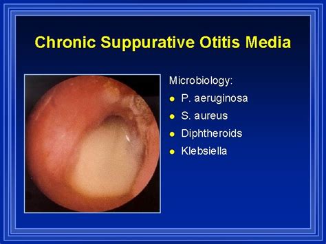 Otitis Media Chronic Pictures