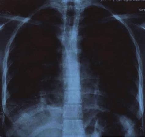 Chest X Ray Showing Mediastinal And Right Hilar Lymphadenopathy With