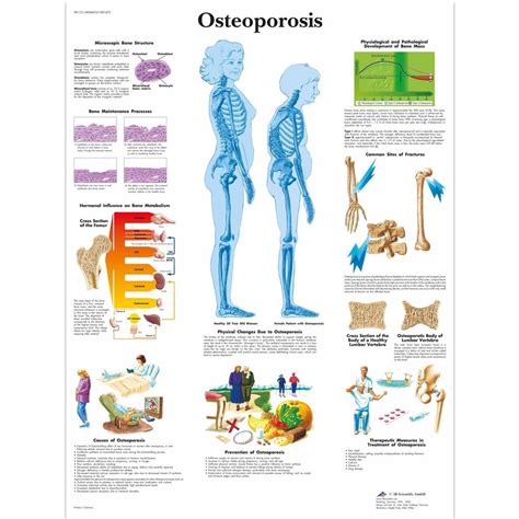 Osteoporosis Anatomical Chart Clinical Charts And Supplies
