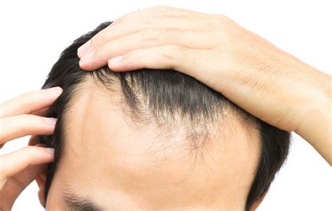 Is Minoxidil An Effective Treatment For A Receding Hairline Ds