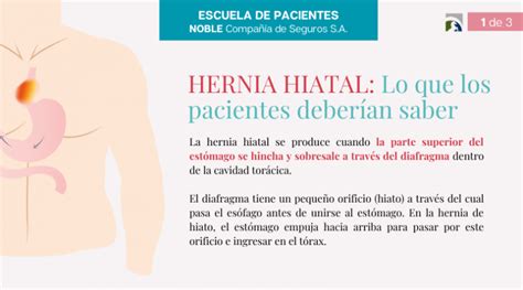 Hernia Hiatal Lo Que Los Pacientes DeberÍan Saber Noble Seguros