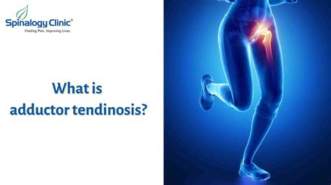 Understanding Adductor Tendinosis Causes Symptoms And Treatment