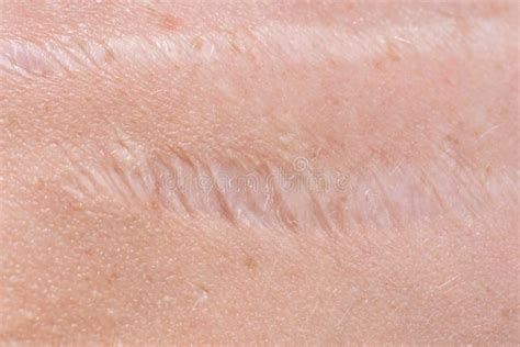 Scar On The Skin Stock Photo Image Of Skin Injury 118456210