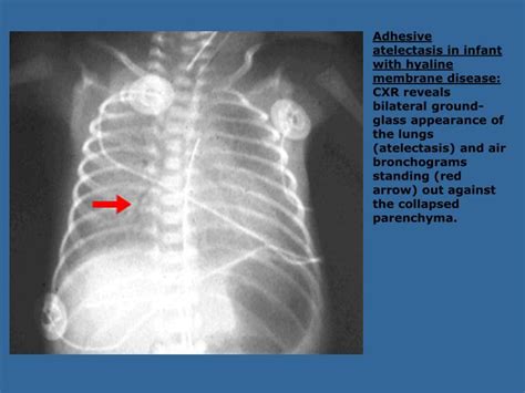What acute disease states create ground glass appearance on chest ct? PPT - Atelectasis PowerPoint Presentation - ID:6185976