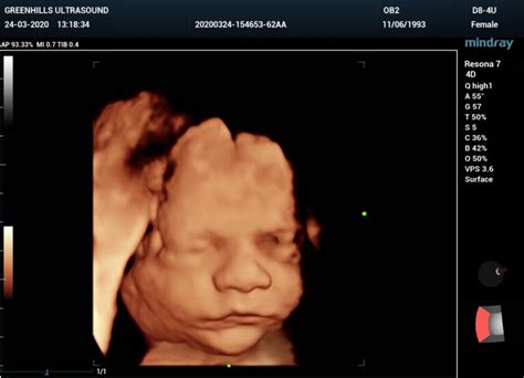 Us Obstetric Nuchal Dating Scan Meaning Ultrasound Gxu Medical