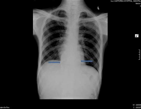 X Ray Chest Postero Anterior View Showing Bird Nest Appearance