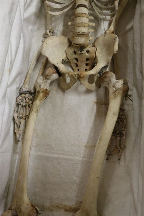 Real Human Skeleton In Nice Victorian Trimmed Casket