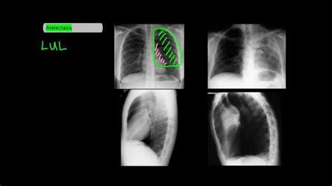 Lobar Atelectasis On Frontal And Lateral Chest X Rays Undergroundmed Frontal X Ray Chest