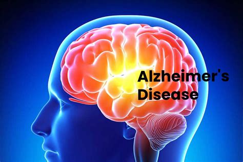 Alzheimers Disease Definition Symptoms Causes And More