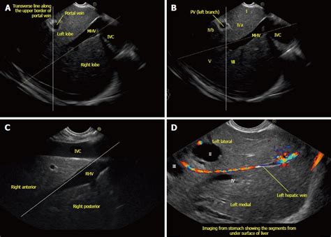 Liver Segment 7 Ultrasound