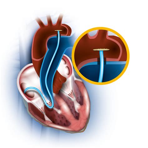 Heart Defect Pda Occlutech Perfecting Performance