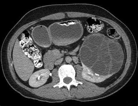 Multilocular Cystic Nephroma A Systematic Literature Review Of The