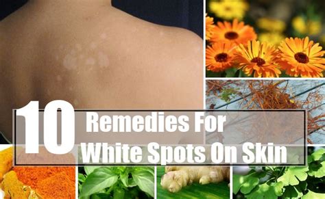 Top 10 Herbal Remedies For White Spots On Skin How To Treat White
