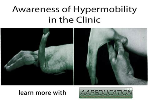 Awareness Of Hypermobility In The Clinic