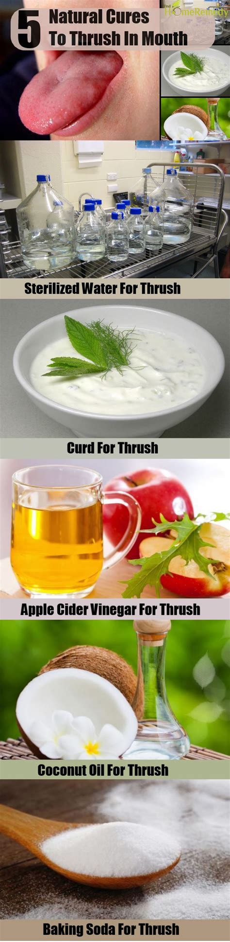 Natural Cure For Thrush In Mouth Effective Ways To Treat Thrush In