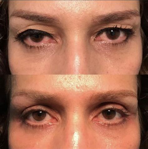 Patient 55495876 Blepharoplasty Eyelid Surgery Before And After
