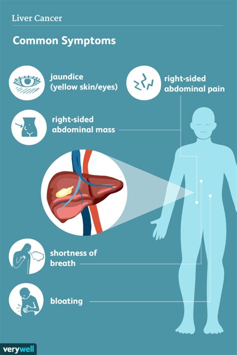 Liver Cancer Signs Symptoms And Complications