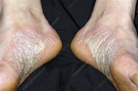 Acute Psoriasis On The Feet Stock Image C0042473 Science Photo