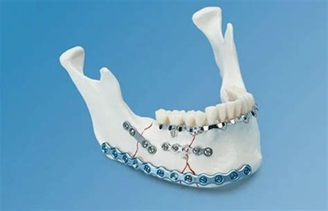 Mandible Implants 4 Hole With Gap Plate At Rs 2500unit Mandible