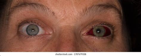 Human Eye Subconjuctival Hemorrhage Broken Blood Stock Photo 1787612615