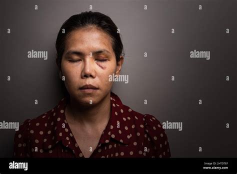 Woman With Bruised Eye Stock Photo Alamy