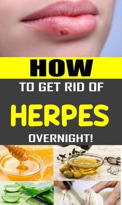 Pin On Herpes Treatment