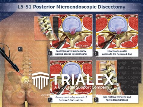 L5 S1 Posterior Microendoscopic Discectomy Trialexhibits Inc