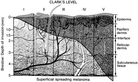 Melanoma Stage And Survival