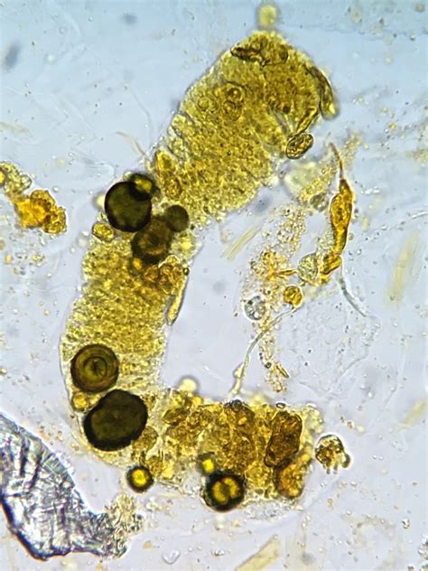 Bilirubin Crystal In Urine