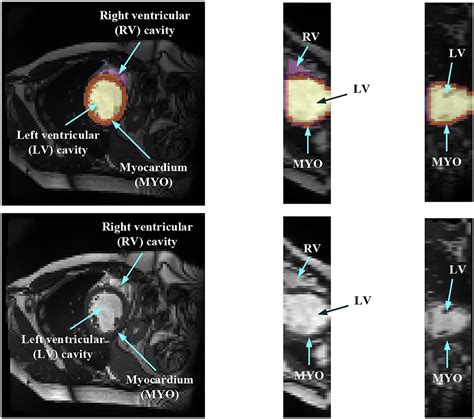 Frontiers Myocardial Segmentation Of Cardiac Mri Sequences With