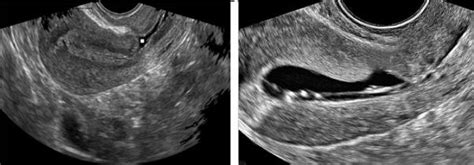 Ultrasonographic Images Of The Uterus The Anechoic Area In The
