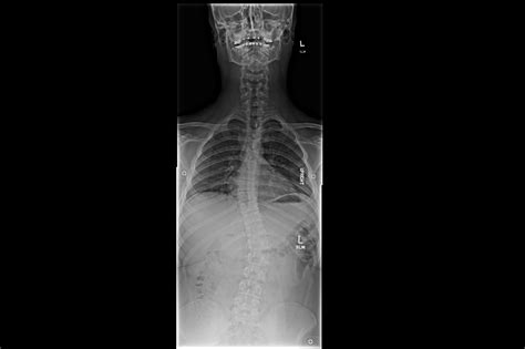 Ortho Dx Evaluation And Management Of Scoliosis Clinical Advisor