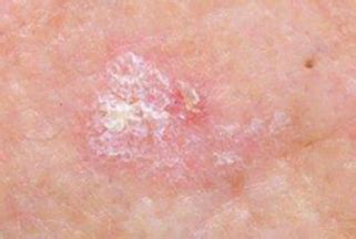 Rough Scaly Patch On Skin Dorothee Padraig South West Skin Health Care