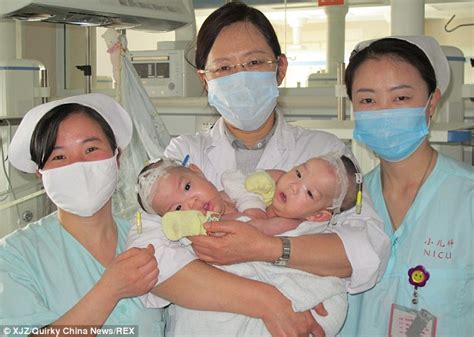 Conjoined Twins Born Sharing A Liver Successfully Separated After Eight
