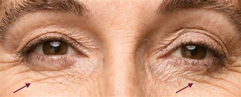 Under Eye Wrinkle Treatment The Ultimate Guide To Banish Fine Lines