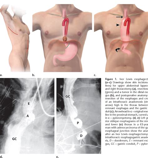 Although reduced length of stay (and therefore costs) were early drivers in er, it is now understood that er pathways reduce perioperative stress response, catabolism, and postoperative complications. Figure 1 from Esophagectomy and Gastric Pull-through ...