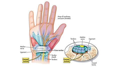 Carpal Tunnel Syndrome Sierra Pacific Orthopedics