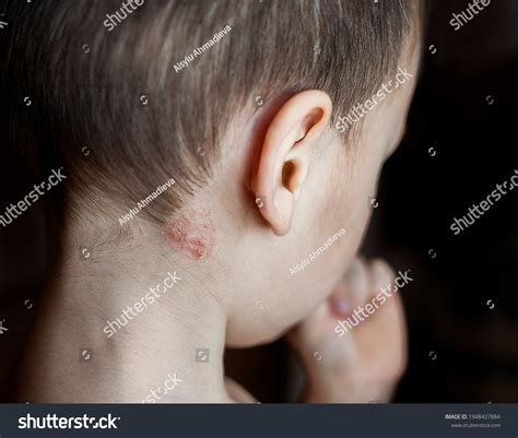 Shingles Fungal Infection On Neck Child ภาพสต็อก 1948427884 Shutterstock