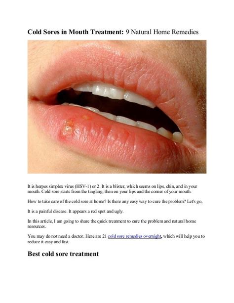 Cold Sores In Mouth Treatment 9 Natural Home Treatments