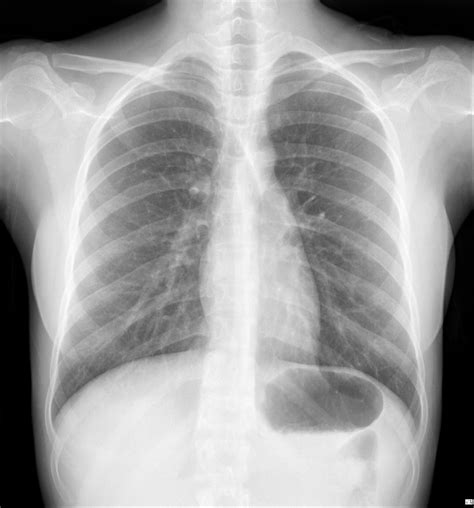 Chest X Ray Interpretation In Patients With Fever Cough Colds