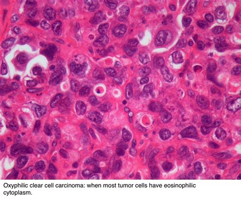 Pathology Outlines Clear Cell Carcinoma