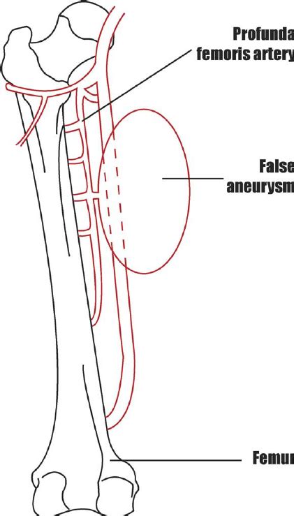 False Aneurysm Of The Profunda Femoris Artery Download Scientific