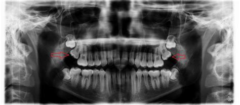Three Common Problems Caused By Wisdom Teeth Dr Tsvetov