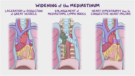 Anatomy Clinical Correlates Mediastinum Video Osmosis