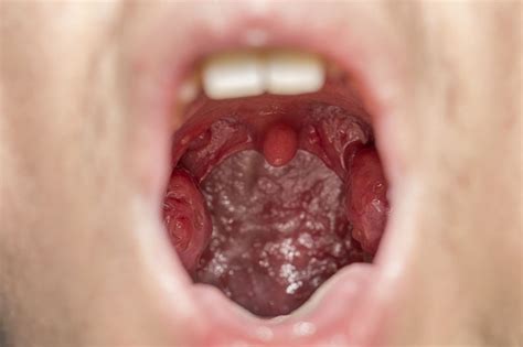 What Are Tonsil Stones Tonsilloliths Symptoms And Treatment Upmc