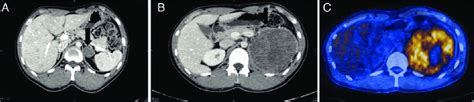A Computerized Tomography Ct Scan Shows A 32 Cm Sized Low Density