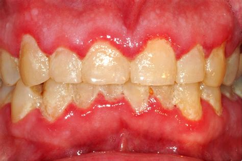 What Is Gingivitis Explained Here Divine Dental Care